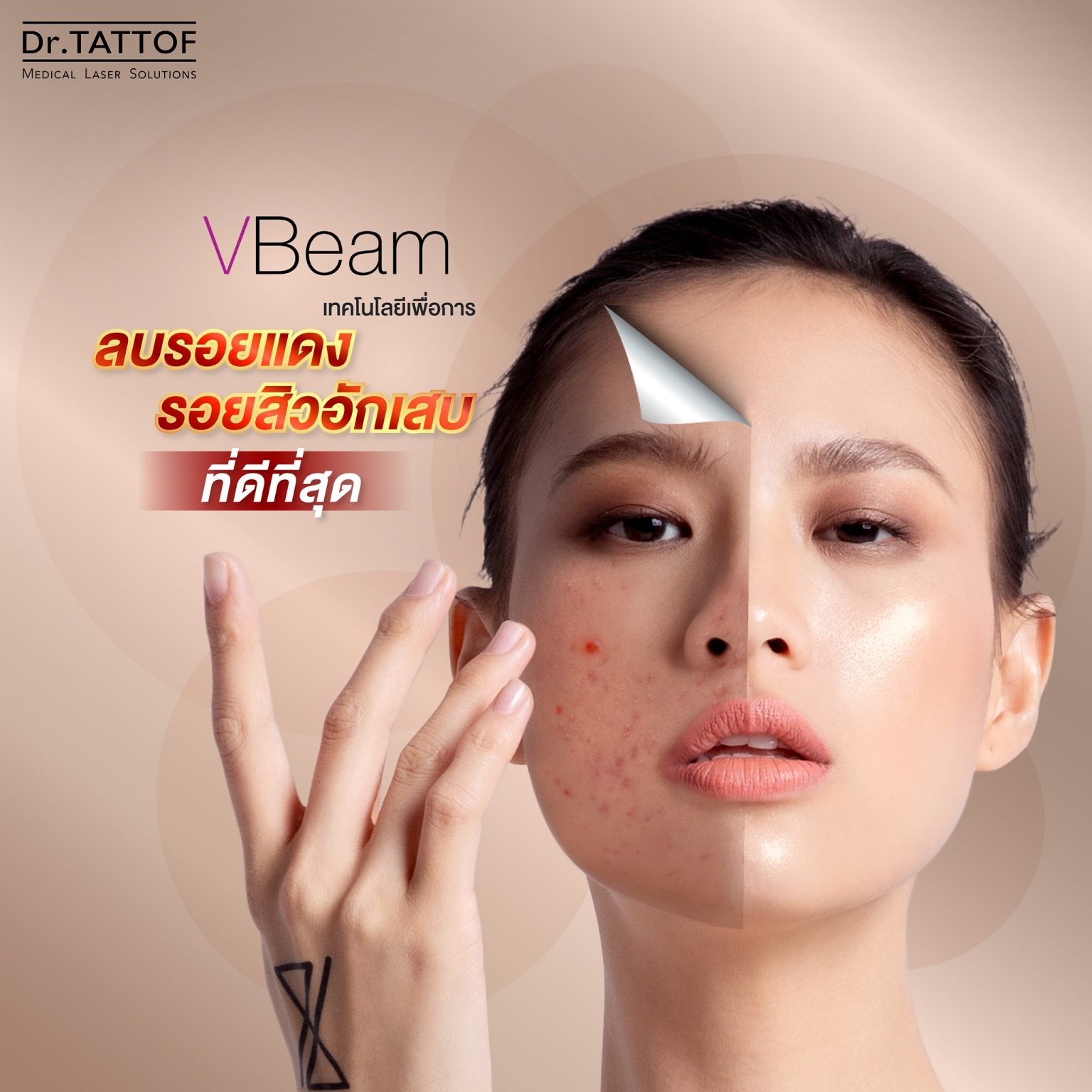 Vbeam Laser ลบรอยแดงสิวอักเสบที่ดีที่สุด Dr Tattof